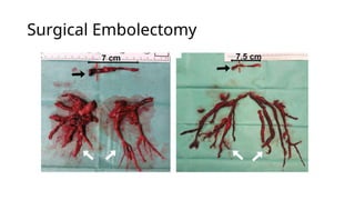 Surgical Embolectomy
 