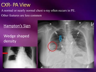 A normal or nearly normal chest x-ray often occurs in PE.
Other features are less common
Hampton’s Sign
Wedge shaped
density
 
