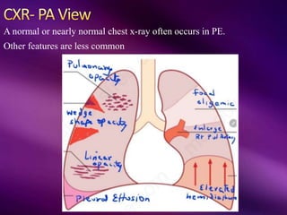 A normal or nearly normal chest x-ray often occurs in PE.
Other features are less common
 