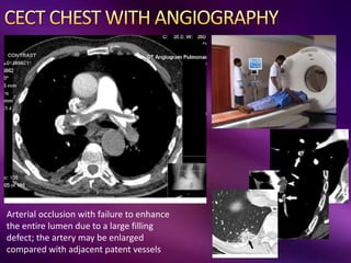 Arterial occlusion with failure to enhance
the entire lumen due to a large filling
defect; the artery may be enlarged
compared with adjacent patent vessels
 
