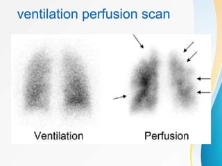 Pulmonary Embolism | PPTX