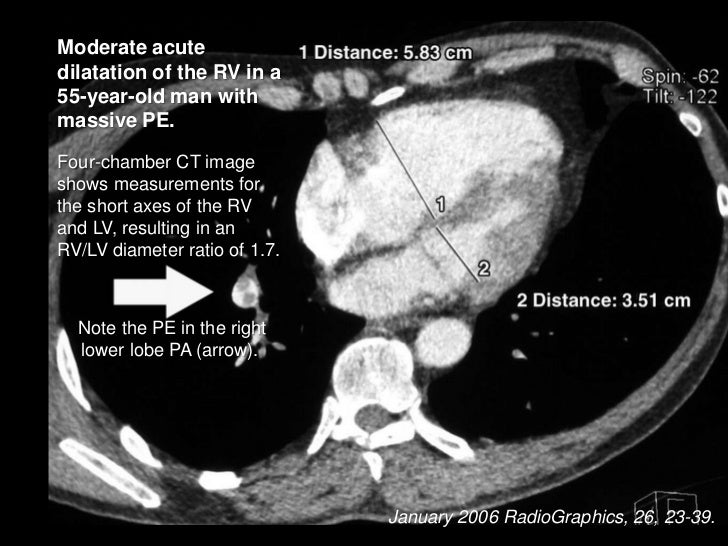 management of massive amp submassive pulmonary embolism define pulmonary embolism