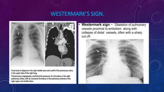 Watermark Sign Radiology Comprehensive Overview of Pulmonary Embolism Diagnosis and Imaging | PDF