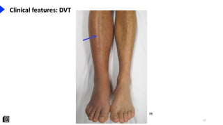 Three Point Dvt Pulmonary Embolism & Deep Vein Thrombosis - Handout.pdf