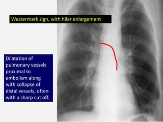 Watermark Sign Radiology Pulmonary Embolism- Diagnosis by Dr.Tinku Joseph | PPTX