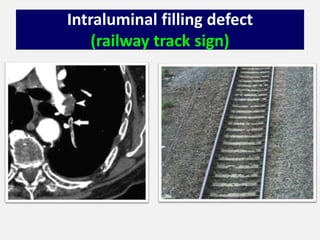 Intraluminal filling defect
(railway track sign)
 