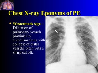 Chest X-ray Eponyms of PE
 Westermark   sign –
 Dilatation of
 pulmonary vessels
 proximal to
 embolism along with
 collapse of distal
 vessels, often with a
 sharp cut off.
 