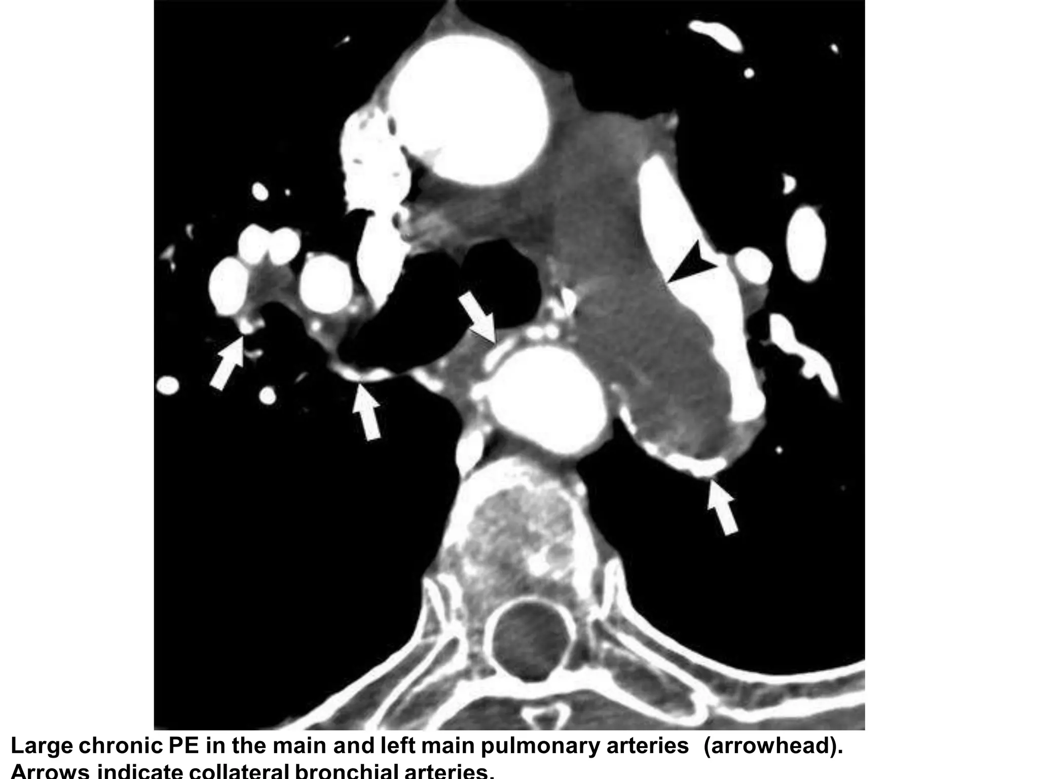 Pulmonary embolism radiology imaging | PPTX