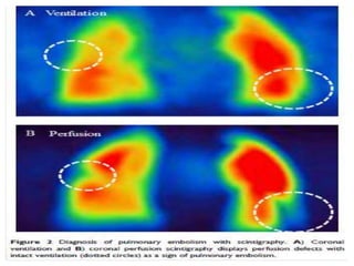 Pulmonary embolism radiology imaging | PPTX