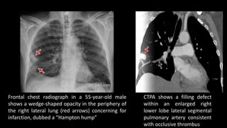 Frontal chest radiograph in a 55-year-old male
shows a wedge-shaped opacity in the periphery of
the right lateral lung (red arrows) concerning for
infarction, dubbed a “Hampton hump”
CTPA shows a filling defect
within an enlarged right
lower lobe lateral segmental
pulmonary artery consistent
with occlusive thrombus
 