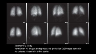 Normal V/Q study
Ventilation [v] images on top row and perfusion [p] images beneath.
No defects are seen in either series.
 