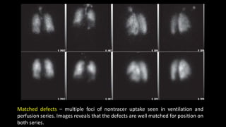 Matched defects – multiple foci of nontracer uptake seen in ventilation and
perfusion series. Images reveals that the defects are well matched for position on
both series.
 