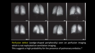 Perfusion defect (wedge-shaped peripherally) seen on perfusion imaging
which is not replicated on ventilation imaging.
This suggests a high probability for the presence of pulmonary embolus.*
 