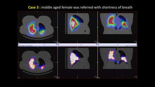 Case 3 : middle aged female was referred with shortness of breath
 
