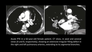Acute PTE in a 62-year-old female patient. CT slices, in axial and coronal
views (A and B, respectively), showing an extensive irregular filling defect in
the right and left pulmonary arteries, extending to its segmental branches.
 