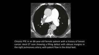 Chronic PTE in an 86-year-old female patient with a history of breast
cancer. Axial CT scan showing a filling defect with obtuse margins in
the right pulmonary artery, with patent flow in the distal bed.
 