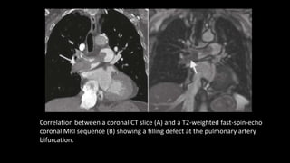 Correlation between a coronal CT slice (A) and a T2-weighted fast-spin-echo
coronal MRI sequence (B) showing a filling defect at the pulmonary artery
bifurcation.
 