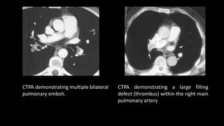 CTPA demonstrating multiple bilateral
pulmonary emboli.
CTPA demonstrating a large filling
defect (thrombus) within the right main
pulmonary artery
 