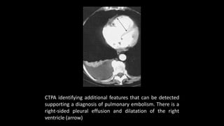 CTPA identifying additional features that can be detected
supporting a diagnosis of pulmonary embolism. There is a
right-sided pleural effusion and dilatation of the right
ventricle (arrow)
 