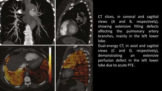 CT slices, in coronal and sagittal
views (A and B, respectively),
showing extensive filling defects
affecting the pulmonary artery
branches, mainly in the left lower
lobe.
Dual-energy CT, in axial and sagittal
views (C and D, respectively),
demonstrating an extensive
perfusion defect in the left lower
lobe due to acute PTE.
 