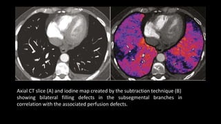 Axial CT slice (A) and iodine map created by the subtraction technique (B)
showing bilateral filling defects in the subsegmental branches in
correlation with the associated perfusion defects.
 