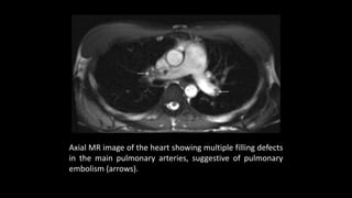 Axial MR image of the heart showing multiple filling defects
in the main pulmonary arteries, suggestive of pulmonary
embolism (arrows).
 