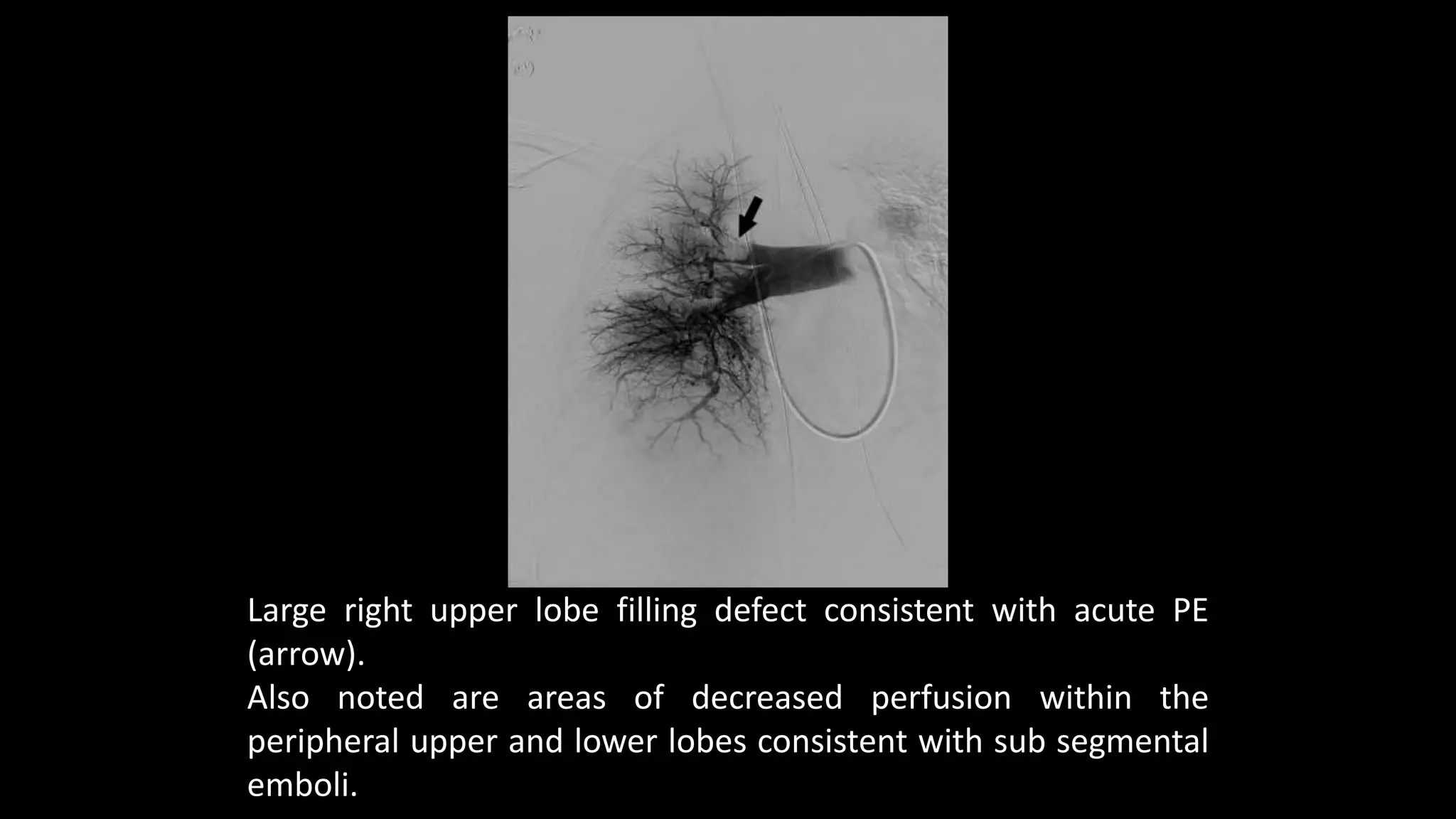 Large right upper lobe filling defect consistent with acute PE
(arrow).
Also noted are areas of decreased perfusion within the
peripheral upper and lower lobes consistent with sub segmental
emboli.
 