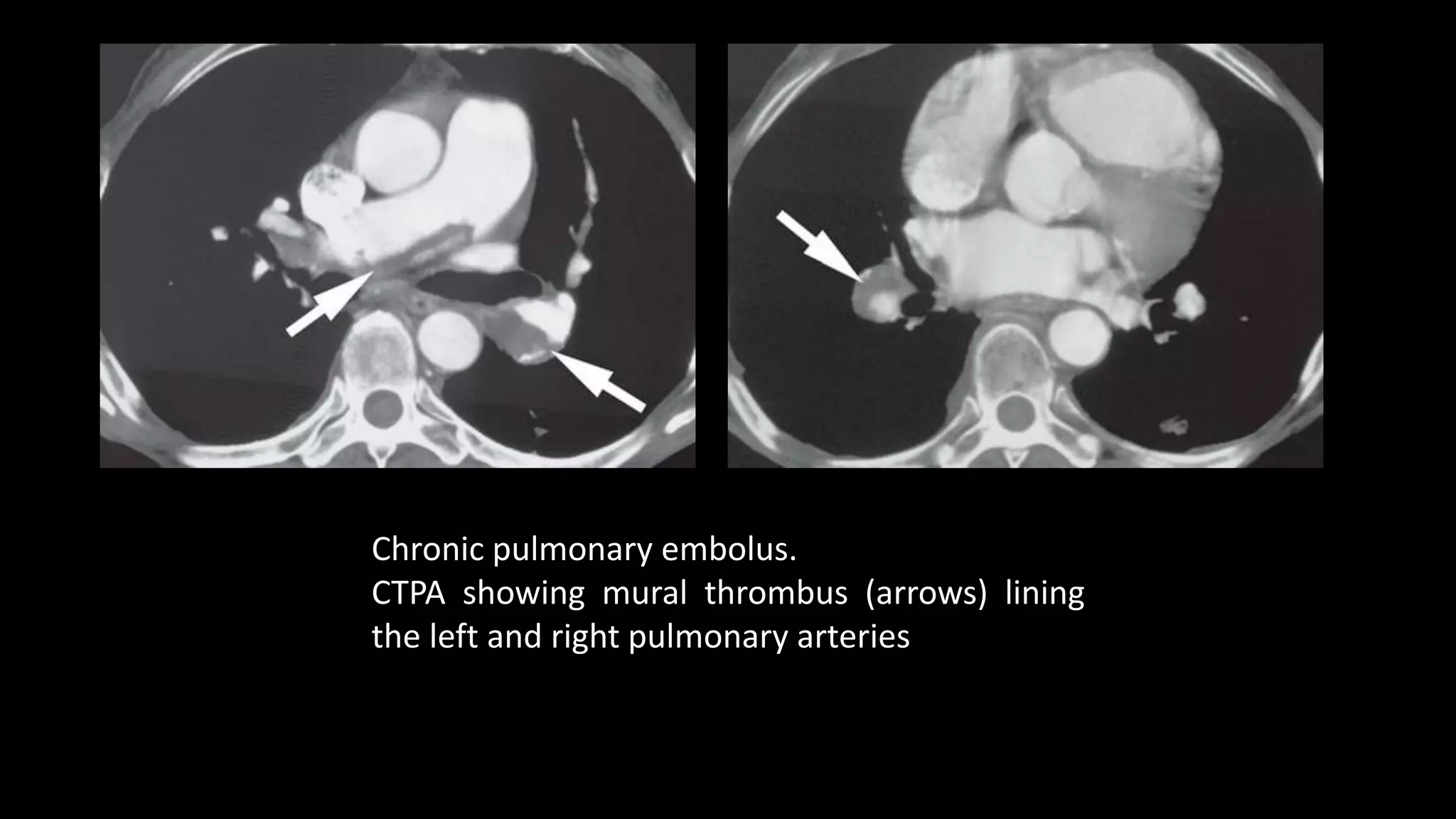 Chronic pulmonary embolus.
CTPA showing mural thrombus (arrows) lining
the left and right pulmonary arteries
 