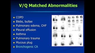 Pulmonary embolism imaging | PPTX