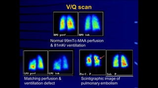 Pulmonary embolism imaging | PPTX