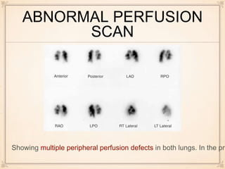 ABNORMAL PERFUSION
SCAN
Showing multiple peripheral perfusion defects in both lungs. In the pre
 