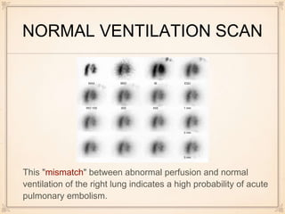 NORMAL VENTILATION SCAN
This "mismatch" between abnormal perfusion and normal
ventilation of the right lung indicates a high probability of acute
pulmonary embolism.
 