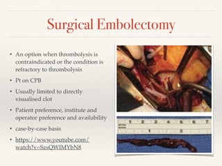 Surgical Embolectomy
• An option when thrombolysis is
contraindicated or the condition is
refractory to thrombolysis
• Pt on CPB
• Usually limited to directly
visualised clot
• Patient preference, institute and
operator preference and availability
• case-by-case basis
• https://www.youtube.com/
watch?v=SzsQWIMYbN8
 