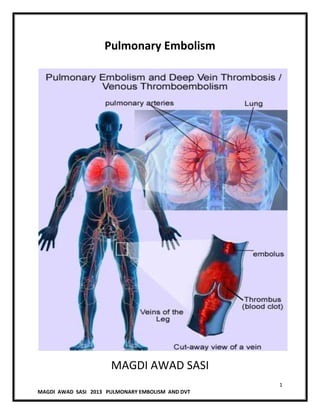 1
MAGDI AWAD SASI 2013 PULMONARY EMBOLISM AND DVT
Pulmonary Embolism
MAGDI AWAD SASI
 