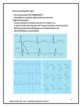 16
MAGDI AWAD SASI 2013 PULMONARY EMBOLISM AND DVT
3.Electrocardiographic Signs:
Sinus tachycardia( THE COMMENEST )
Incomplete or complete right bundle branch block
Right-axis deviation
T wave inversions in leads III and aVF or in leads V1-V4
S wave in lead I and a Q wave and T wave inversion in lead III (S1Q3T3)
QRS axis greater than 90 degrees or an indeterminate axis
Atrial fibrillation or atrial flutter
 