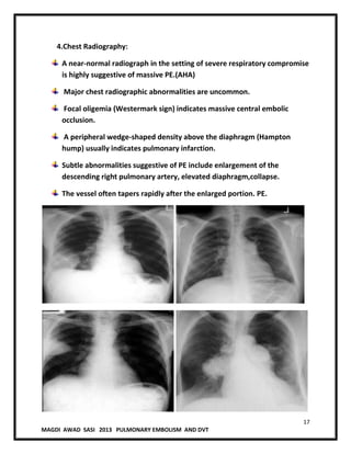17
MAGDI AWAD SASI 2013 PULMONARY EMBOLISM AND DVT
4.Chest Radiography:
A near-normal radiograph in the setting of severe respiratory compromise
is highly suggestive of massive PE.(AHA)
Major chest radiographic abnormalities are uncommon.
Focal oligemia (Westermark sign) indicates massive central embolic
occlusion.
A peripheral wedge-shaped density above the diaphragm (Hampton
hump) usually indicates pulmonary infarction.
Subtle abnormalities suggestive of PE include enlargement of the
descending right pulmonary artery, elevated diaphragm,collapse.
The vessel often tapers rapidly after the enlarged portion. PE.
 