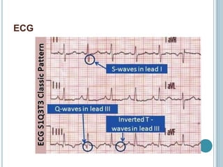 ECG
 