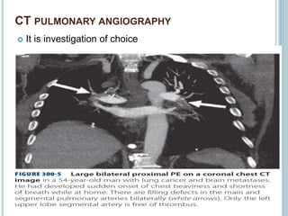 CT PULMONARY ANGIOGRAPHY
 It is investigation of choice
 