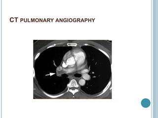 CT PULMONARY ANGIOGRAPHY
 