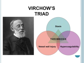 VIRCHOW’S
TRIAD
 