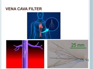VENA CAVA FILTER
 