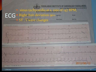  sinus tachycardia at a rate of 147 BPM,
ECG  Right Axis deviation 90+
             ST , T wave changes




7/18/2012                                               7
 
