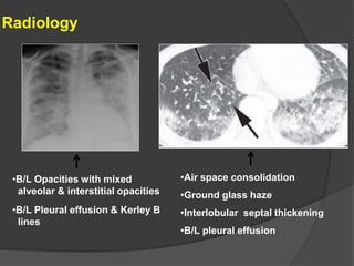 Radiology
•B/L Opacities with mixed
alveolar & interstitial opacities
•B/L Pleural effusion & Kerley B
lines
•Air space consolidation
•Ground glass haze
•Interlobular septal thickening
•B/L pleural effusion
 