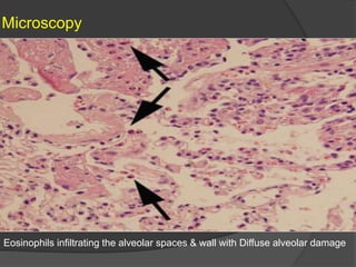 Microscopy
Eosinophils infiltrating the alveolar spaces & wall with Diffuse alveolar damage
 