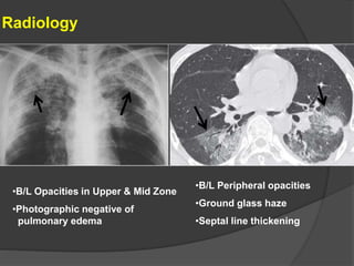 Radiology
•B/L Opacities in Upper & Mid Zone
•Photographic negative of
pulmonary edema
•B/L Peripheral opacities
•Ground glass haze
•Septal line thickening
 