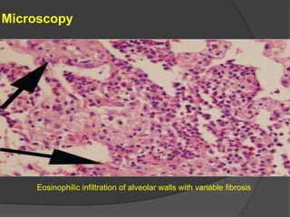 Microscopy
Eosinophilic infiltration of alveolar walls with variable fibrosis
 