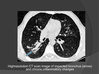 Highresolution CT scan image of impacted bronchus (arrow)
and chronic inflammatory changes
 