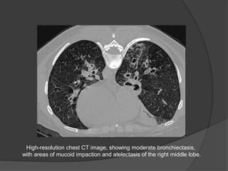 High-resolution chest CT image, showing moderate bronchiectasis,
with areas of mucoid impaction and atelectasis of the right middle lobe.
 
