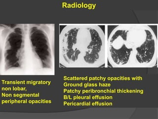 Radiology
Transient migratory
non lobar,
Non segmental
peripheral opacities
Scattered patchy opacities with
Ground glass haze
Patchy peribronchial thickening
B/L pleural effusion
Pericardial effusion
 