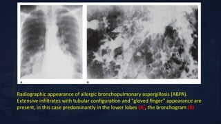 Comprehensive Overview of Secondary Pulmonary Eosinophilic Disorders ...
